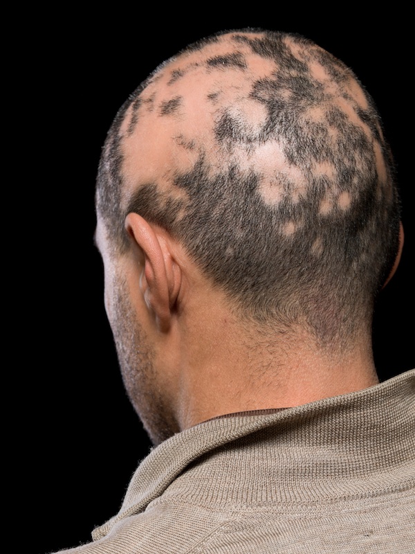 Alopecia | Prasadini Hospital | Puttur