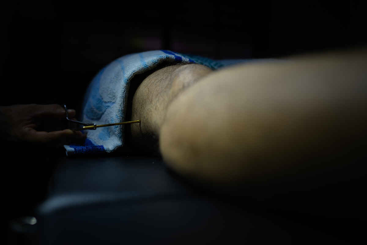 Agni Karma | Prasadini Hospital